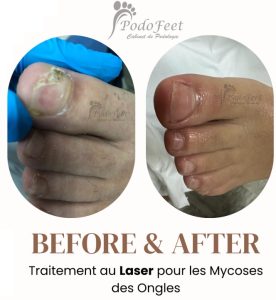 Mycoses des ongles et pied diabétiques - Podologue Ariana