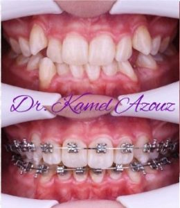 Aligneurs et appareil dentaire invisible - Orthodontiste Kamel Azzouz