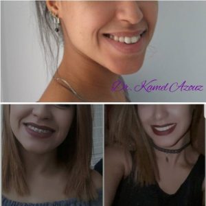 Appareil orthodontique et invisalign à Sousse- Dr Kamel Azzouz