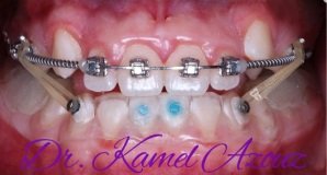 Invisalign et orthodontie Sousse - Cabinet Dr Kamel Azzouz