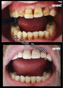 Blanchiment des dents - dentiste Dr Rim Ben Ali