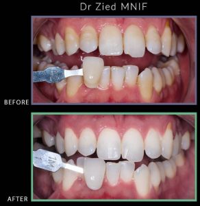 Blanchiment dentaire à Jardins El Menzah - Dentiste Zied Mnif