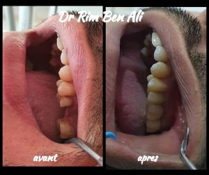 Dentiste à Radès Dr Rim Ben Ali - Couronne en zircone