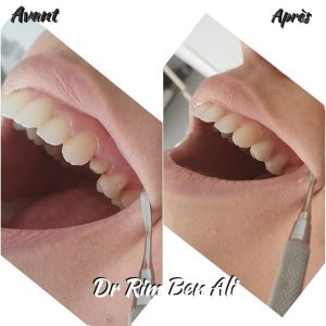 Prothèse dentaire et couronne en céramique - Dentiste à Radès