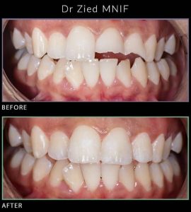 Dentiste Jardins Menzah - détartrage des dents et couronne en zircone