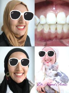 Orthodontiste à Sousse Dr Azzouz - Esthetic smile et invisalign