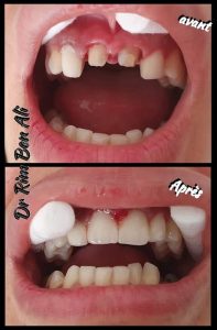 Médecin dentiste à Rades - Implant et bridge dentaire