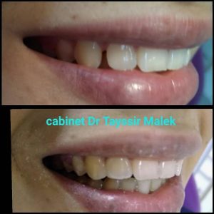 Blanchiment dentaire - Dr Tayssir Malek dentiste Sousse Riadh
