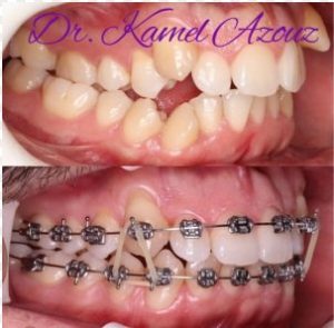Orthodontiste Sousse Bab Bher -Esthetic Smile et aligneurs