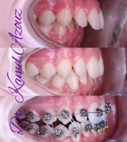 Appareil orthodontique à Sousse - Esthetic smile et invisalign