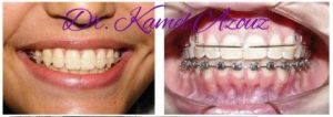 Orthodontie enfant à Sousse - Dr Kamel Azzouz