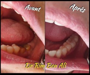 Bridge et prothèse dentaire à Rades - Dentiste Rim Ben Ali