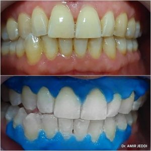 Blanchiment et implant dentaire à Msaken - Dr Amir Jeddi