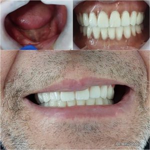 Prothèse et facette dentaire - dentiste Implantologiste Msaken