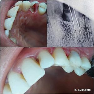 Endodontie et implantologie à Msaken - Dentiste Amir Jeddi