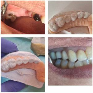 Implant dentaire et soins de caries - Dentiste Ali Bourguiba