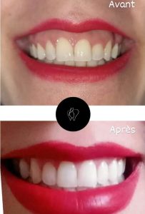 Implant et blanchiment dentaire à Sousse - Dr Rabeb Ben Fredj