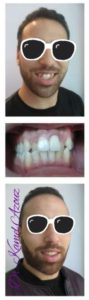 Avant Après orthodontiste Sousse - Esthetic Smile Dr Kamel Azzouz