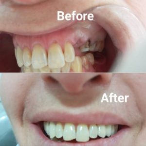 couronne-implant-dentaire-a-sfax-dr-khadija-dammak