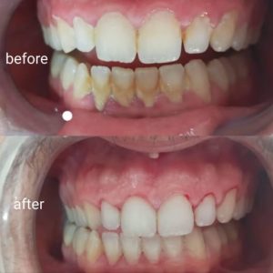 dr-khdija-dammak-detartrage-dents-a-sfax