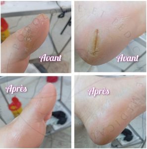 avant-apres-cabinet-podologie-sousse-moknine