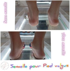 semelles-pour-pied-valgues-chez-chaima-slimene