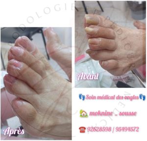 soin-medical-des-ongles-sousse-moknine