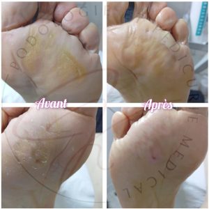 soins-pied-ongles-incarnes-moknine